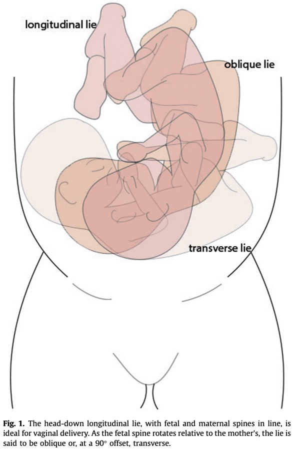 An experimental approach to a simplified model of human birth